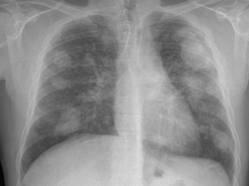 maquinas de captacion de polvo para prevención de la silicosis